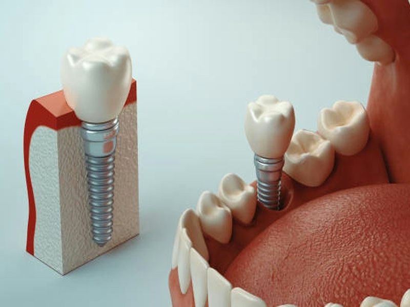 Model of a dental implant with a crown