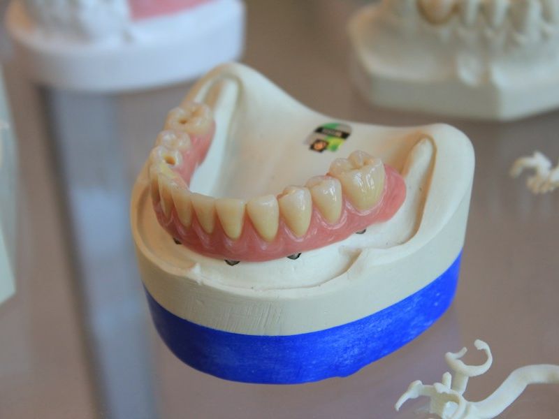 Partial denture on a dental model